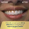 Waterpik Cordless Advanced 2.0 Water Flosser For Teeth, Gums, Braces, Dental Care With Travel Bag and 4 Tips, ADA Accepted, Rechargeable, Portable, and Waterproof, Black WP-582, Packaging May Vary