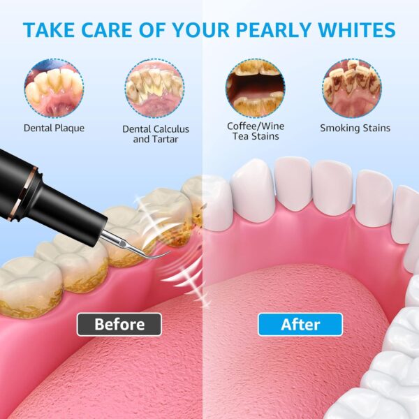 Plaque Remover for Teeth, Teeth Cleaning Kit with Ultrasonic Tooth Cleaner and Dental Tools, Dental Picks for Teeth Cleaning and Rechargeable Plaque Blaster with LED, Tartar Remover, 4 Heads