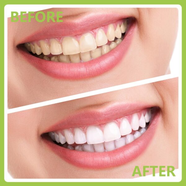 71VBQj6JnL._AC_SL1500_.jpg Dental Tools, Professional Teeth Cleaning Oral Care Hygiene Kit, Stainless Steel Dental Pick Tooth Scraper Tartar Plaque Remover for Dentist, Personal, Pet Use with Storage Box