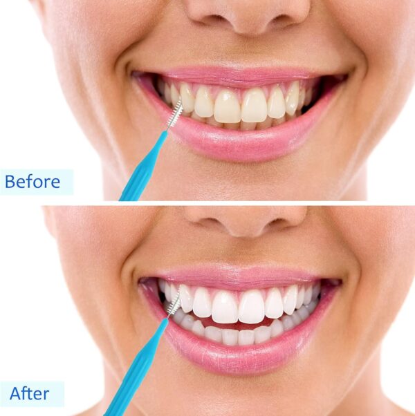 Patelai 100 Pieces Braces Brush for Cleaner Interdental Brush Toothpick Dental Flossing Head Oral Hygiene Flosser Tooth Cleaning Tool (Stylish Colors)